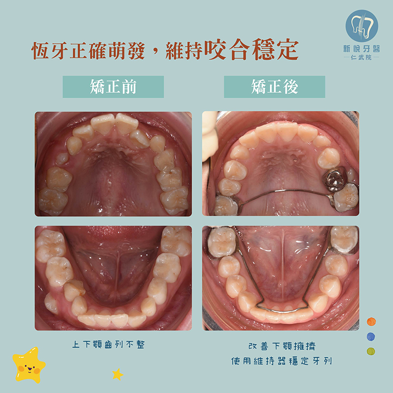 兒童矯正困難案例｜小佑的恆牙萌發挑戰的第4張圖片